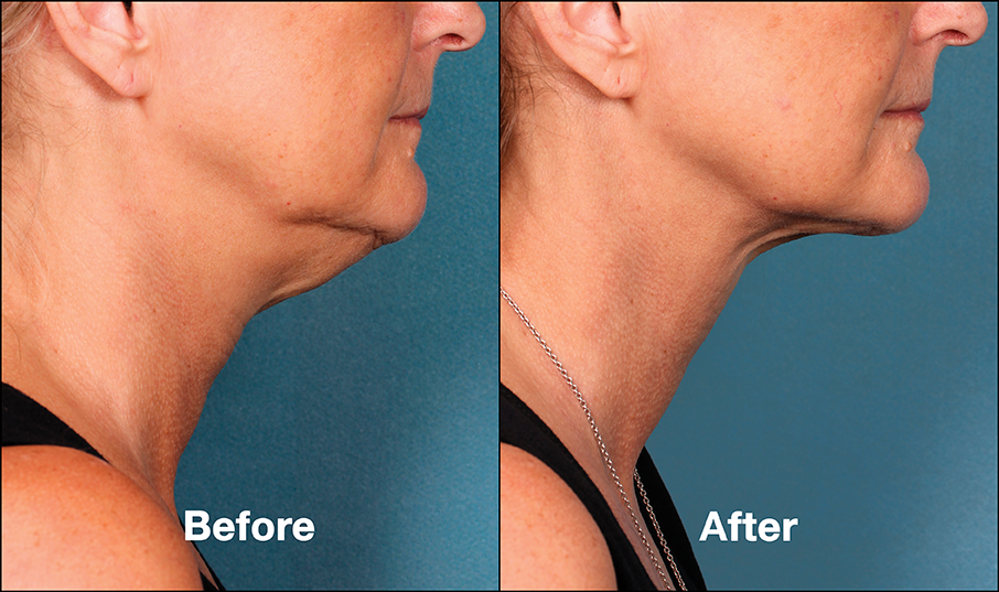 Kybella Treatment Age Perfectly